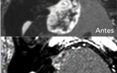 Schwannomas vestibulares ¿Qué son y cómo se tratan?
