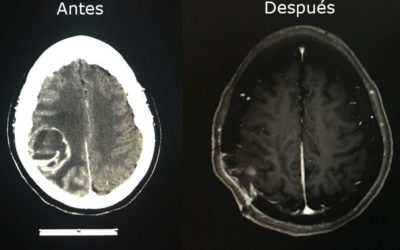 Metástasis Cerebrales