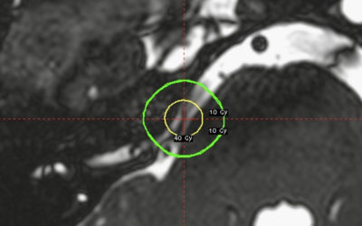 Neuralgia del Trigémino
